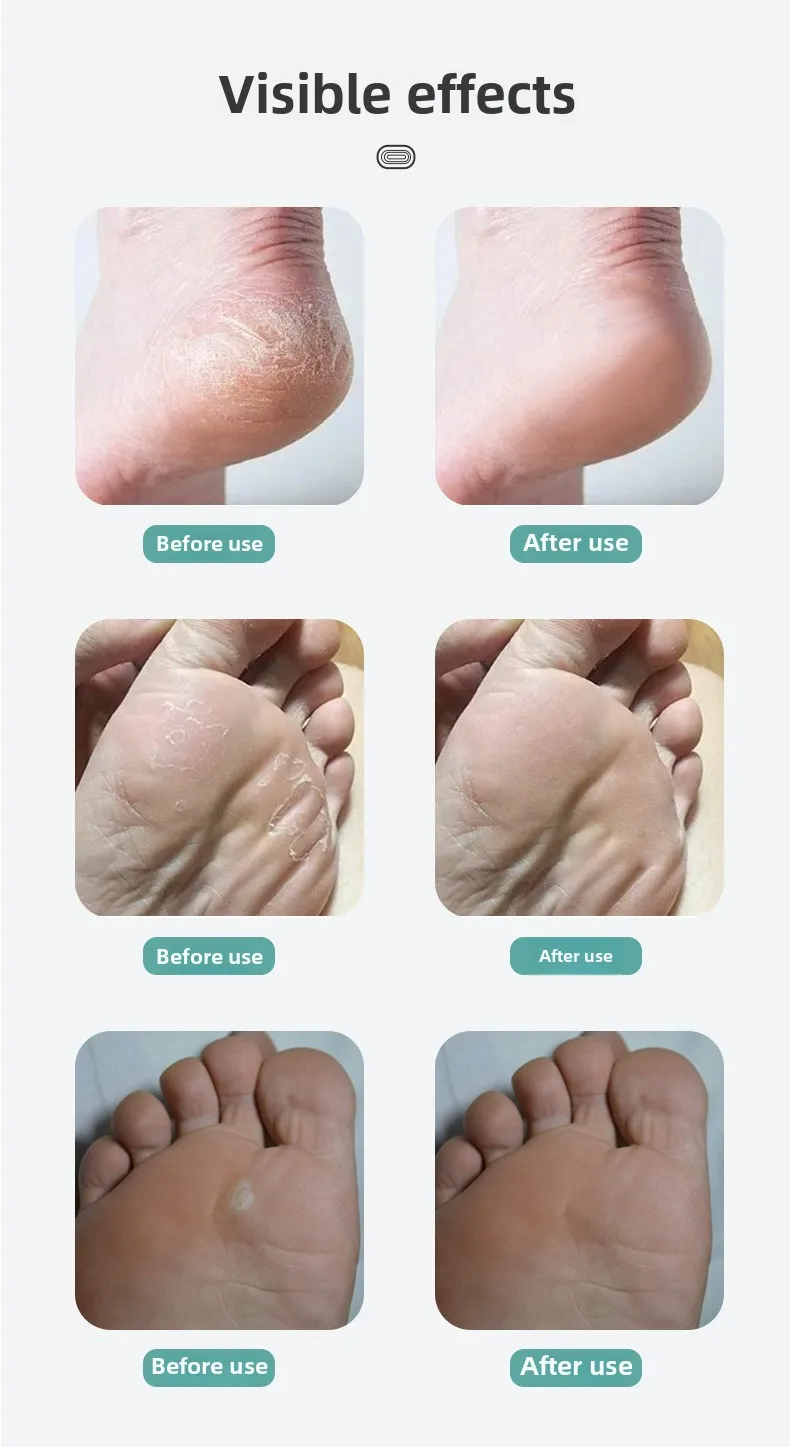 Removedor de Calos Elétrico Recarregável USB GOODSKY com Display Digital, Pedicure em Casa como Presente - Imagem 4