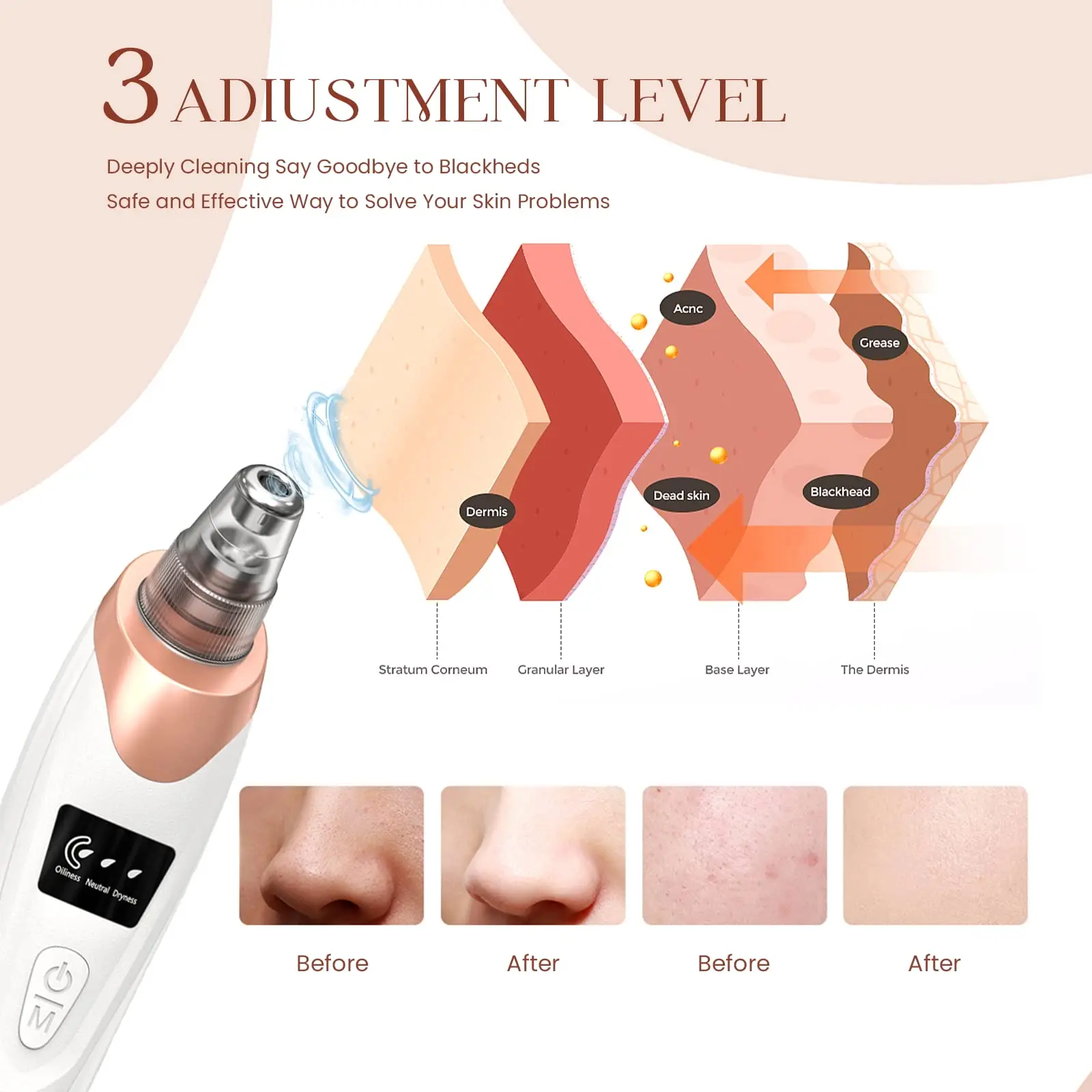 Removedor de Cravos Elétrico com Sucção para Limpeza Facial - Imagem 3