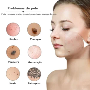 Caneta de Plasma para Remoção de Manchas e Verrugas com 19 Níveis